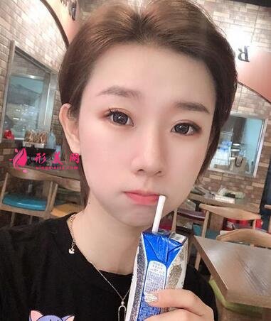 河北省二院整形美容科張卓男雙眼皮案例術(shù)后恢復效果圖展示【實拍】