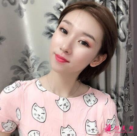 河北省二院整形美容科張卓男雙眼皮案例術(shù)后恢復效果圖展示【實拍】