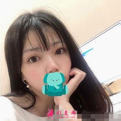 咸陽長城整形美容醫(yī)院怎么樣?價格表|雙眼皮案例分享