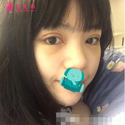 咸陽長城整形美容醫(yī)院怎么樣?價格表|雙眼皮案例分享
