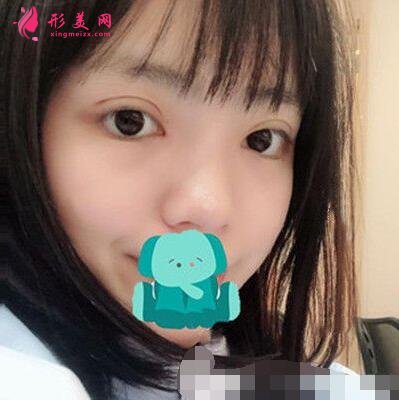 咸陽長城整形美容醫(yī)院怎么樣?價格表|雙眼皮案例分享
