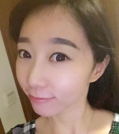 廣州倍生女性發(fā)際線調整案例