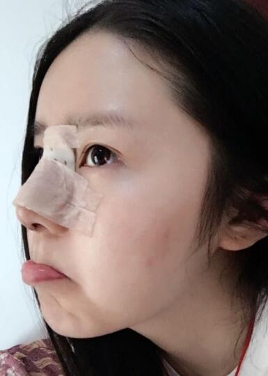 鼻綜合整形案例和恢復(fù)過程圖分享——寧波尚美整形美容醫(yī)院