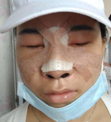 在寧波尚美醫(yī)院做的鼻子綜合整形效果不錯