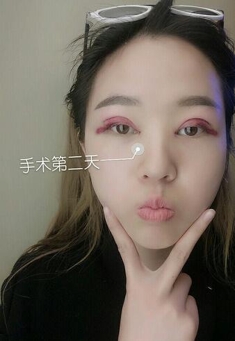 廣州妍雅割雙眼皮+開(kāi)眼角恢復(fù)日記