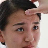 肉毒素去抬頭紋眉間紋恢復(fù)過(guò)程圖，真實(shí)案例分享