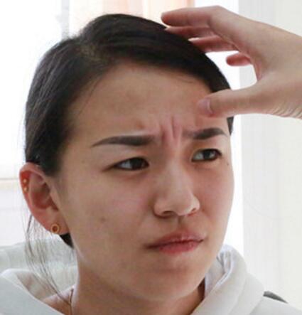 肉毒素去抬頭紋眉間紋恢復(fù)過程圖，真實案例分享