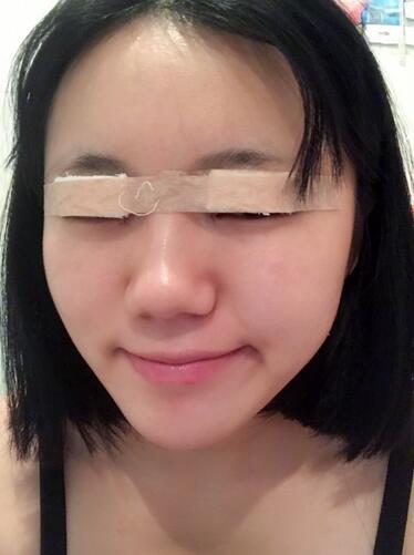 成都美未央雙眼皮恢復過程日記