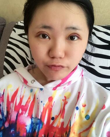 成都美未央雙眼皮恢復過程日記