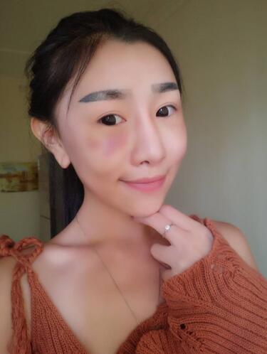 武漢愛美匯自體脂肪填充全臉經(jīng)驗(yàn)