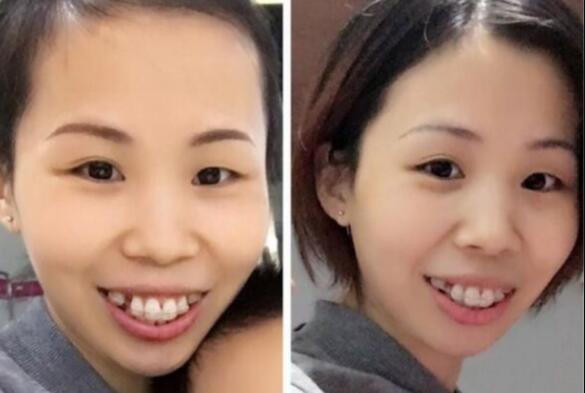 牙齒矯正的最佳年齡，多對(duì)比圖真實(shí)案例分享——成都格林口腔