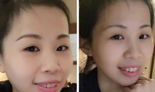 牙齒矯正的最佳年齡，多對(duì)比圖真實(shí)案例分享——成都格林口腔