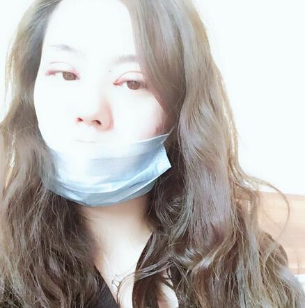 武漢樂美開眼角+雙眼皮3個(gè)月恢復(fù)圖片