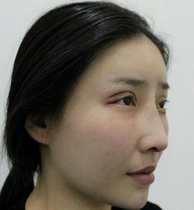 武漢西嬋康美達(dá)拉斯隆鼻+眼部綜合整形