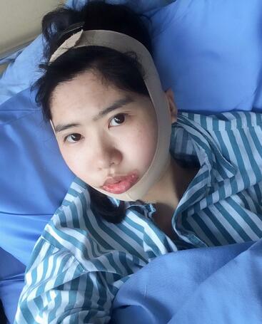 北京八大處下頜角截骨前后效果對比