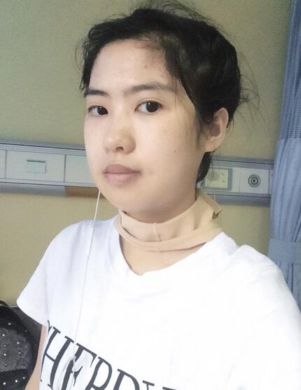 北京八大處下頜角截骨前后效果對比