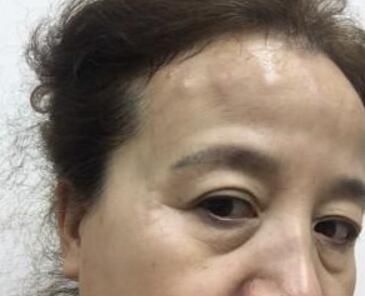去抬頭紋最好的方法？肉毒素去抬頭紋魚尾紋