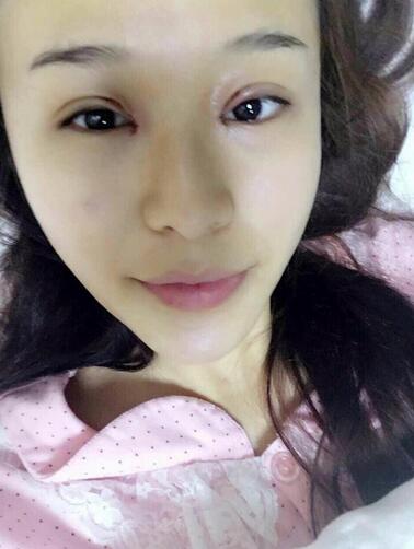 杭州科發(fā)源龍都整形開眼角+割雙眼皮恢復記錄