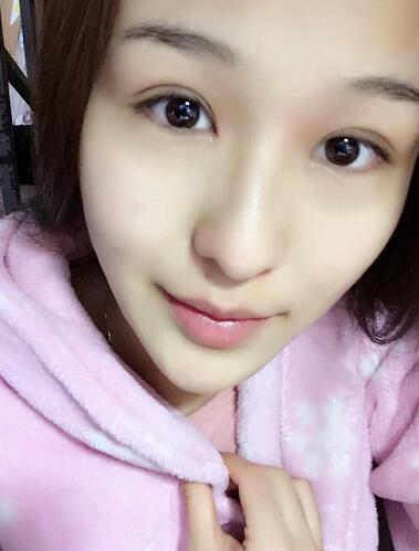 杭州科發(fā)源龍都整形開眼角+割雙眼皮恢復記錄