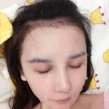 發(fā)際線調(diào)整效果對(duì)比圖 杭州科發(fā)源龍都發(fā)際線種植