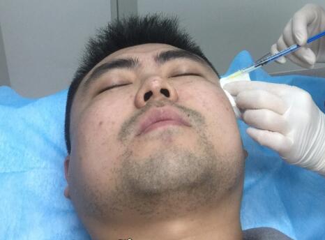 男生注射肉毒素去除抬頭紋魚尾紋案例分享