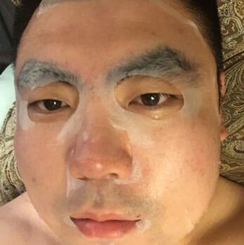 男生注射肉毒素去除抬頭紋魚尾紋案例分享