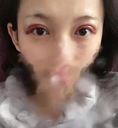 天津繆慈割雙眼皮恢復(fù)圖