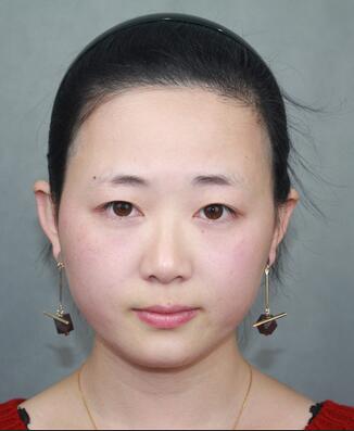 全切雙眼皮恢復(fù)過程 天津伊頌雙眼皮案例