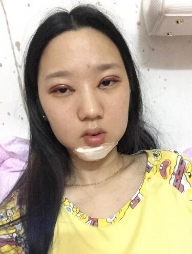 雙眼皮前后對(duì)比照 天津麗姿雙眼皮兩個(gè)月