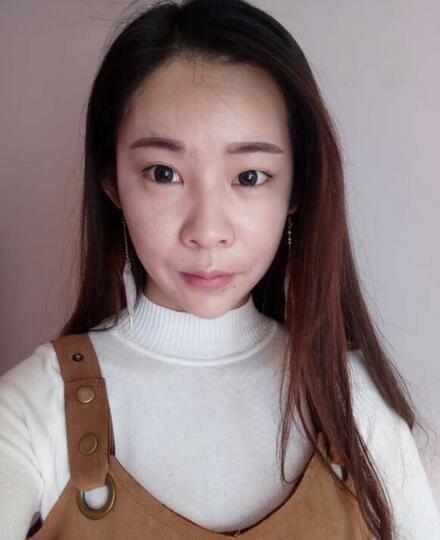 北京醫(yī)院錢文江切開雙眼皮恢復(fù)過程