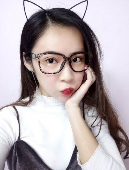 北京醫(yī)院錢文江切開雙眼皮恢復(fù)過程