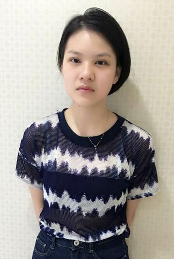 眼綜合術(shù)后1-7天恢復(fù)圖 天津麗姿眼綜合前后對(duì)比