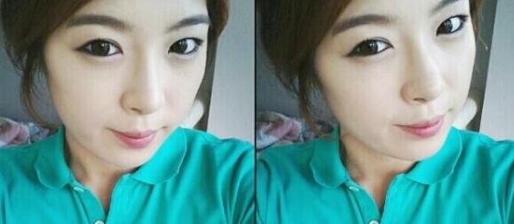 武漢藝齡整形醫(yī)院做駝峰鼻矯正價格12k，真實案例恢復(fù)過程圖