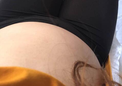 抽脂減肥瘦腰腹手術(shù)價格1.3w真實案例前后對比圖