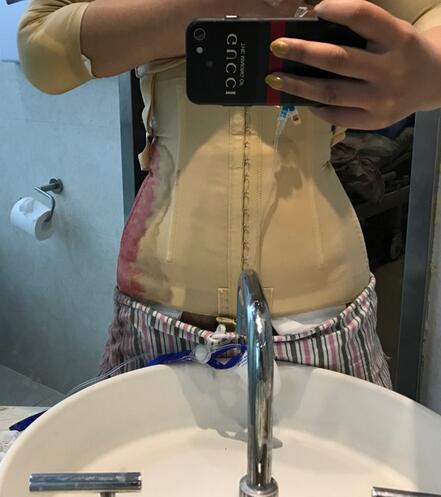 腹部吸脂兩個月親身經歷 深圳仁安雅吸脂案例