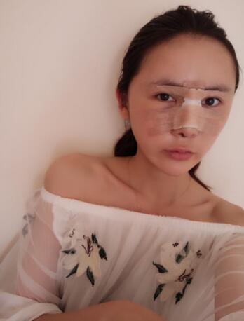 耳軟骨隆鼻+硅膠隆鼻5個月 深圳仁安雅黃印資做的