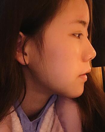 北京藝星王英勇隆鼻案例 鼻綜合三個月