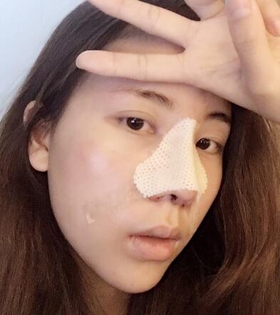 北京藝星王英勇隆鼻案例 鼻綜合三個月