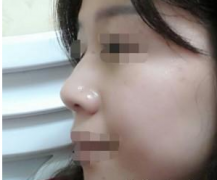 玻尿酸隆鼻 讓面部更加立體美觀