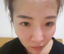 玻尿酸豐全臉 做個看起來柔和的女人